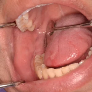 Síndromes genéticos en odontología: Diagnóstico y manejo clínico