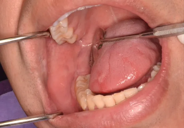 Síndromes genéticos en odontología: Diagnóstico y manejo clínico